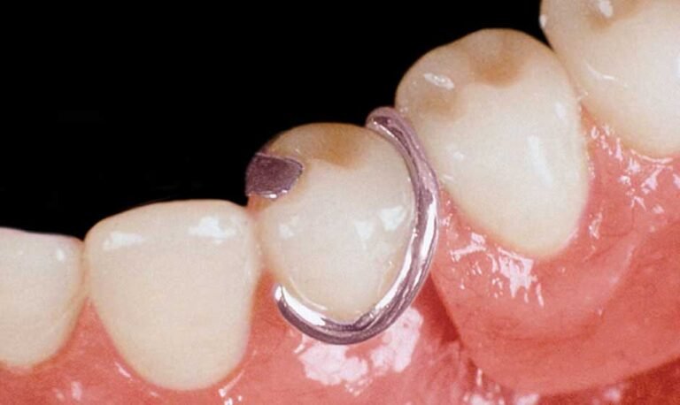 Benefits of a Unilateral Removable Partial Denture