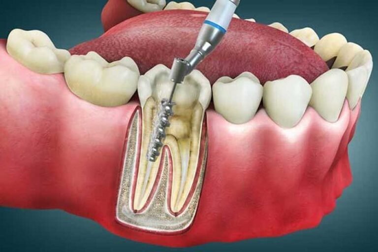 Tooth in Trouble