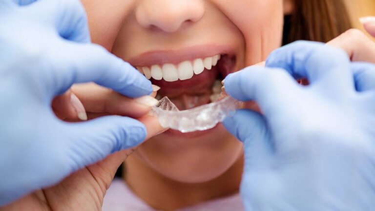 What Customization Means on Clear Braces Made for Las Vegas Teens