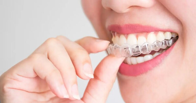 Teeth Aligners Solution