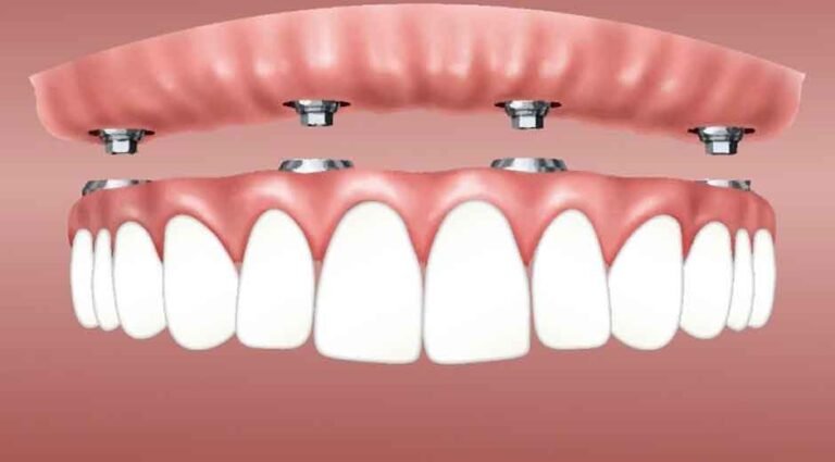 From Dentures to Implants: Making the Switch to a Full Mouth Solution